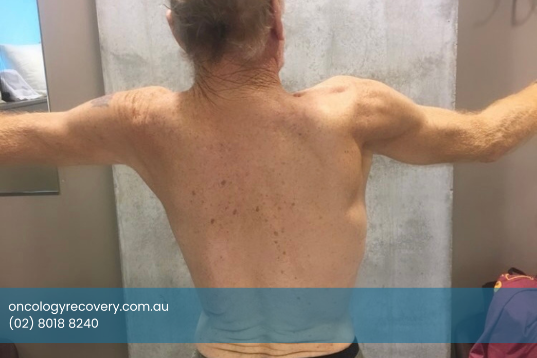shoulder pain after neck dissection 